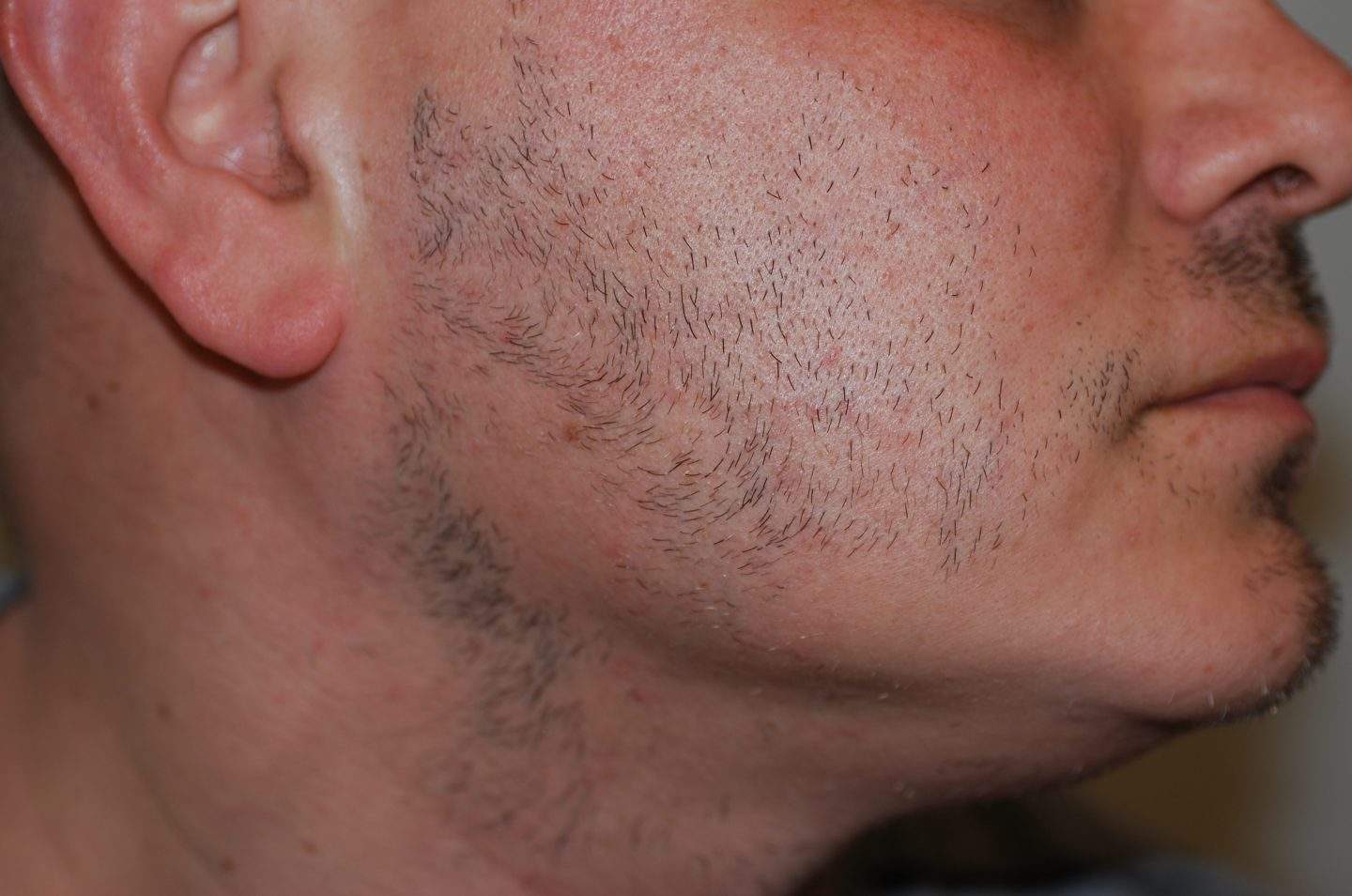Chiazze di alopecia areata della barba