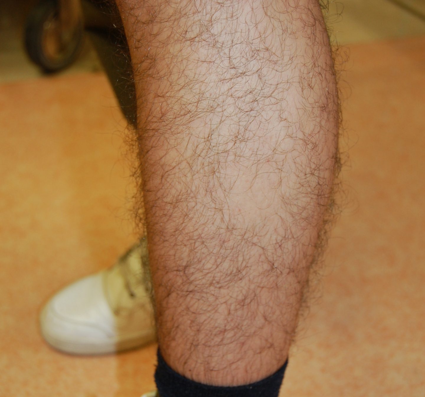 Una chiazza di alopecia areata dei peli della gamba