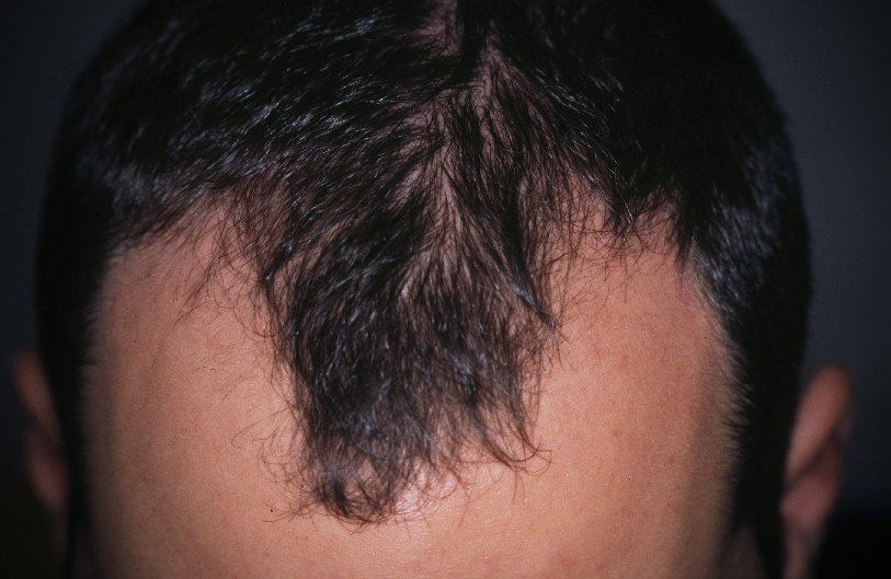 Alopecia androgenetica maschile: la stempiatura è uno dei segni iniziali