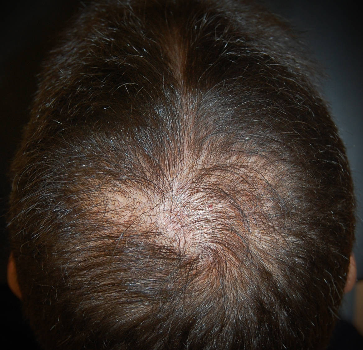 Alopecia androgenetica maschile: l'assottigliamento dei capelli al vertice provoca la "chierica"
