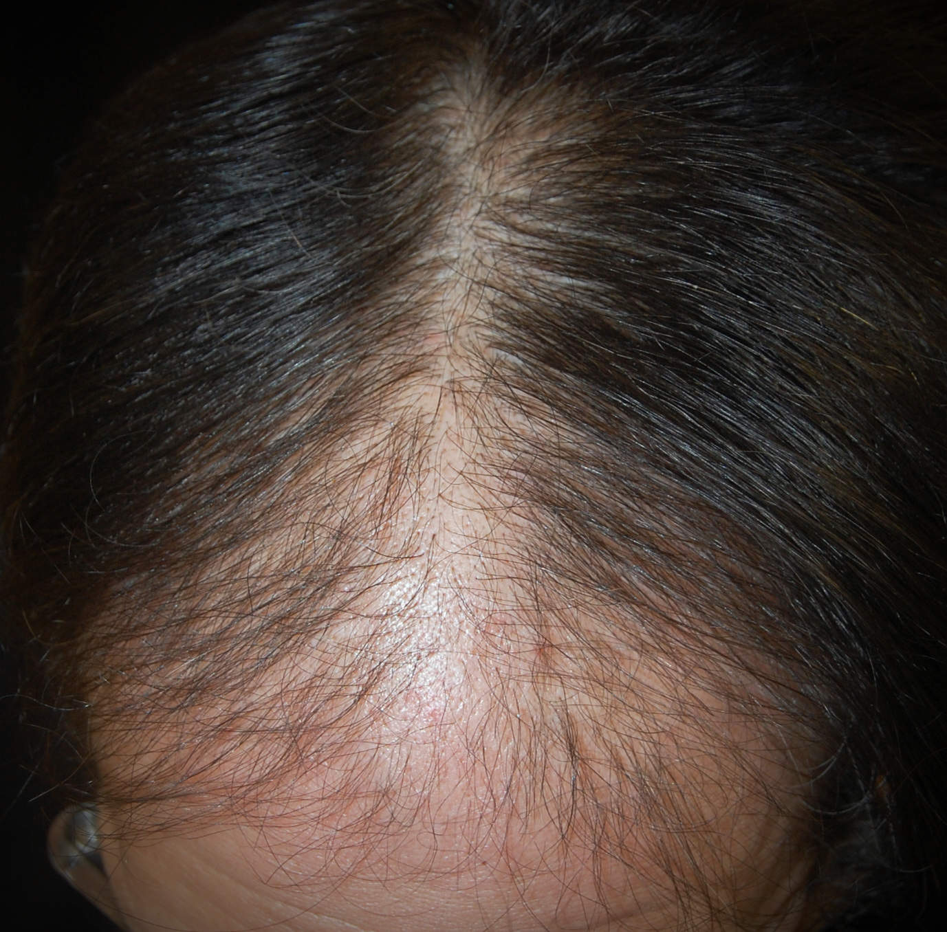 Alopecia androgenetica maschile: a volte è colpita la zona anteriore del capo, e il diradamento dei capelli permette di vedere la cute