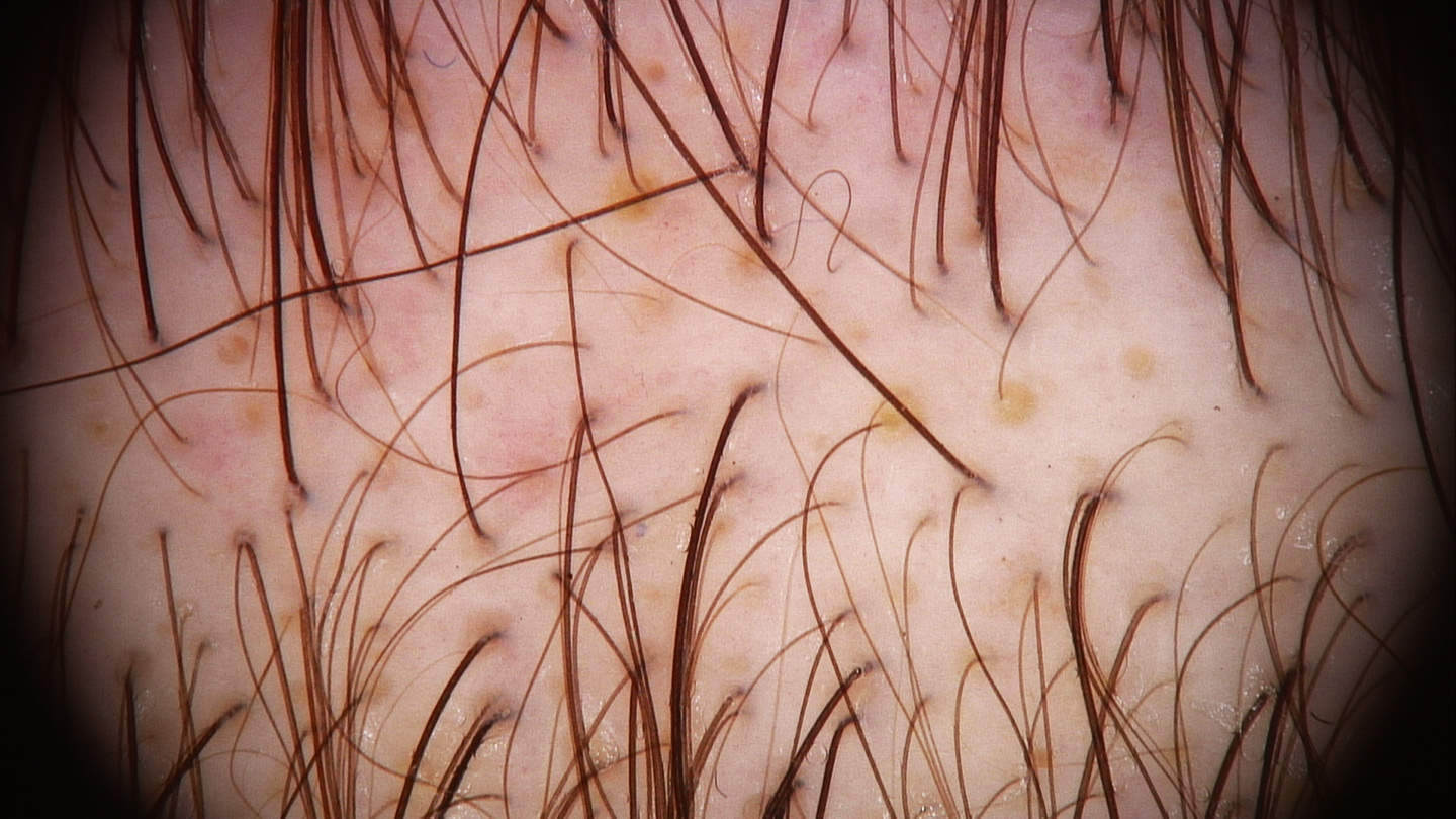 La dermoscopia nell'alopecia androgenetica 