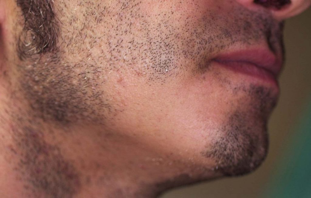 Alopecia areata della barba