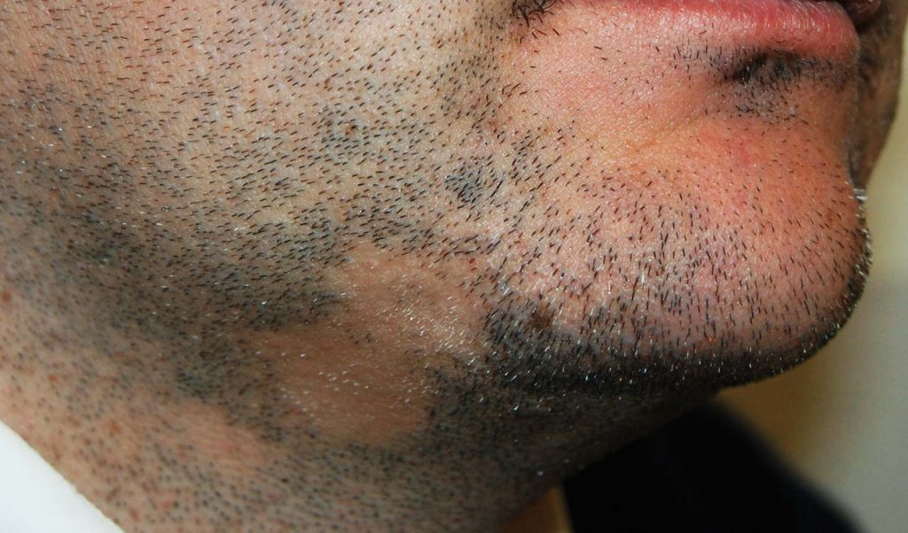 Alopecia areata della barba