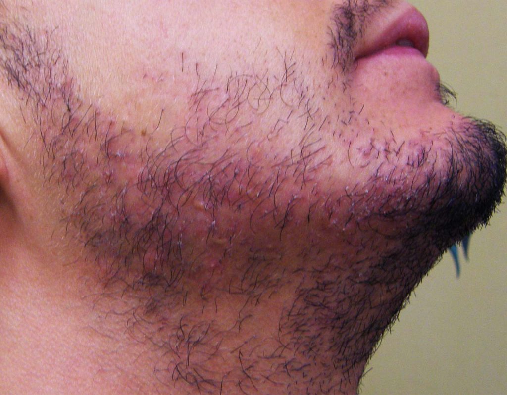 Follicoliti della barba