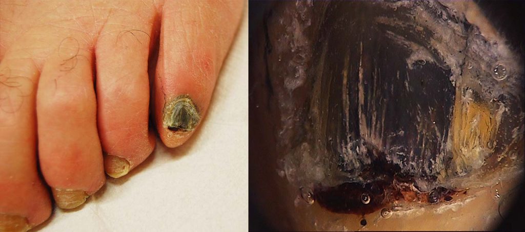 Ematoma "cronico": l'unghia del V dito del piede è completamente nera, anche sotto alla cuticola. La dermoscopia mostra lo stravaso ematico subungueale e permette le diagnosi di ematoma
