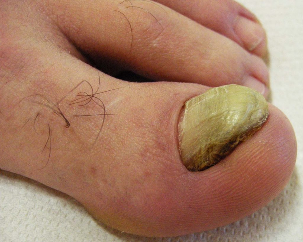 Onicogrifosi dell'alluce: l'unghia è ispessita ad artiglio, opaca, giallastra e difficile da tagliare