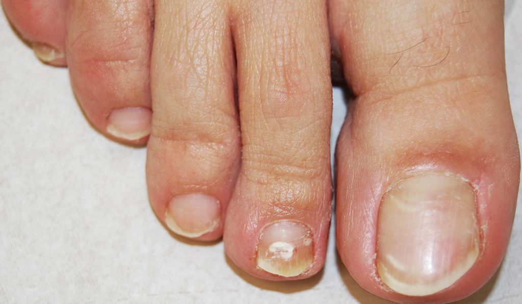 Malattie delle unghie dei piedi: Onicomicosi bianca superficiale del 2° dito del piede: chiazzette bianche opache sulla superficie della lamina
