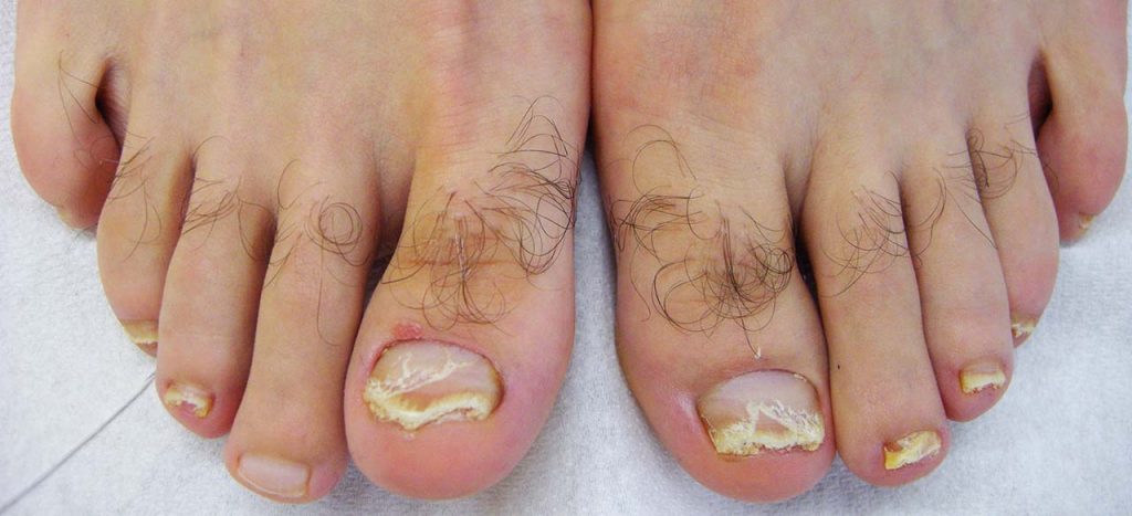 Psoriasi delle unghie dei piedi: le unghie sono staccate e sollevate da squame e il margine dell’onicolisi ha un tipico bordo rosa salmone. Da notare l’associata fragilità di superficie della lamina