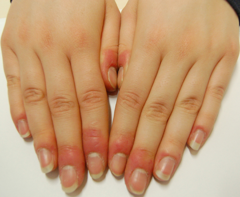 Risultati immagini per dermatite allergica professionale unghie