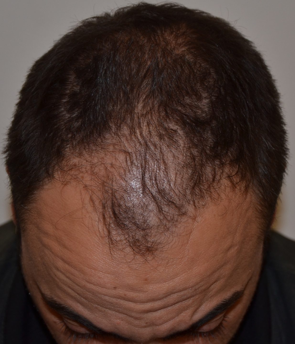 Alopecia Androgenetica Come Riconoscerla E Come Curarla